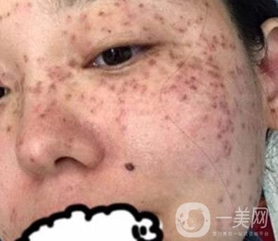 哈醫(yī)大四院整形美容科*新價格表公布,附祛斑真人案例