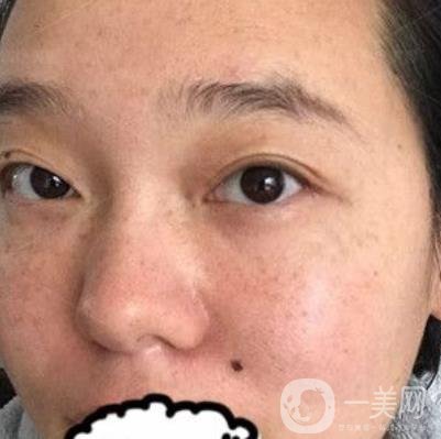 哈醫(yī)大四院整形美容科*新價格表公布,附祛斑真人案例