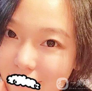 哈醫(yī)大四院整形美容科*新價格表公布,附祛斑真人案例