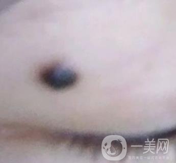 青醫(yī)附院王彥進(jìn)去痣怎么樣？?jī)r(jià)格表及*果展示