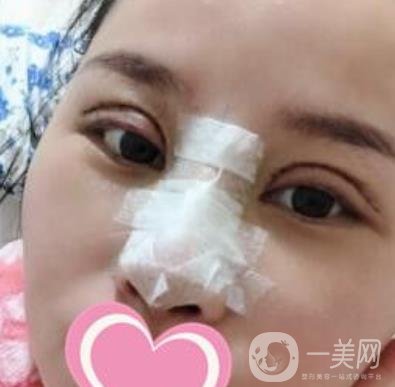 沈陽名流整形醫(yī)院價格表，附雙眼皮+隆鼻案例