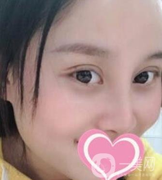 沈陽名流整形醫(yī)院價格表，附雙眼皮+隆鼻案例