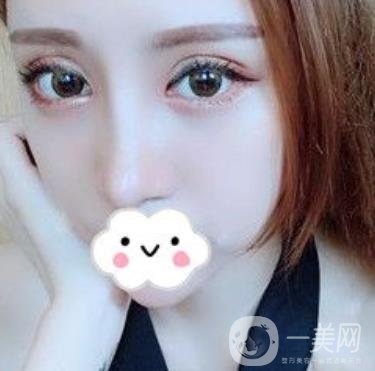 臺(tái)州博雅美惠醫(yī)療美容整形雙眼皮恢復(fù)日記，內(nèi)附價(jià)格表明細(xì)