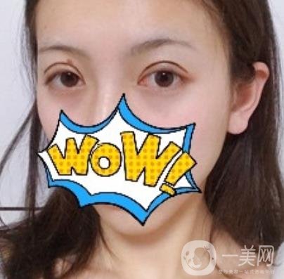 武漢艾萊美醫(yī)療整形醫(yī)院價格表項目收費明細，附雙眼皮案例