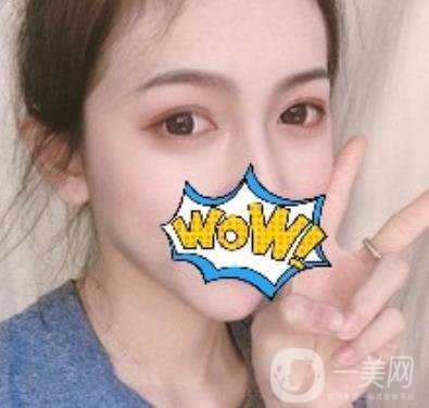 武漢艾萊美醫(yī)療整形醫(yī)院價格表項目收費明細，附雙眼皮案例