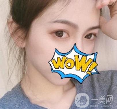 武漢艾萊美醫(yī)療整形醫(yī)院價格表項目收費明細，附雙眼皮案例