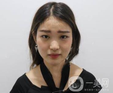 西安華旗唯美整形醫(yī)院做*多少錢(qián)？?jī)r(jià)格表收費(fèi)明細(xì)和案例分享