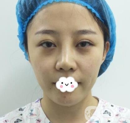 合肥中山醫(yī)院整形科價(jià)格表2020，附雙眼皮恢復(fù)*果