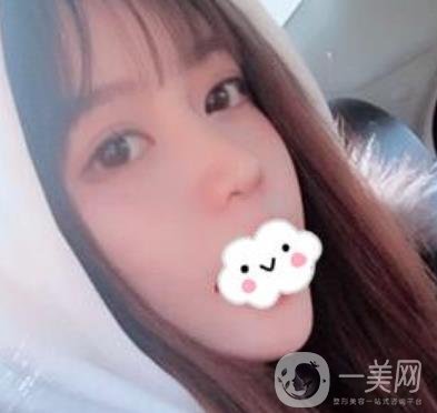 合肥中山醫(yī)院整形科價(jià)格表2020，附雙眼皮恢復(fù)*果