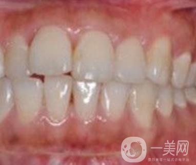 武漢大學(xué)口腔醫(yī)院牙齒矯正多少錢?*果好嗎?價格費(fèi)用明細(xì)一覽