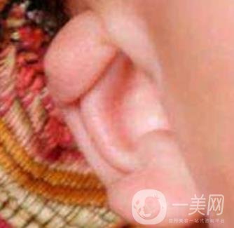 中國醫(yī)學(xué)科學(xué)院整形外科醫(yī)院外耳再造技術(shù)如何?*果好嗎?價(jià)格表收費(fèi)標(biāo)準(zhǔn)一覽