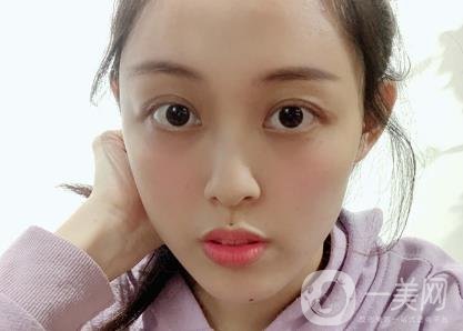 成都美容整形醫(yī)院做脂肪填充全臉*果靠譜嗎?近期價格表和案例參考