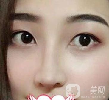 交大一附院王瑞做鼻子怎么樣？?jī)r(jià)格表及術(shù)后*果分享