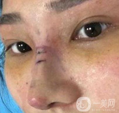 交大一附院王瑞做鼻子怎么樣？?jī)r(jià)格表及術(shù)后*果分享