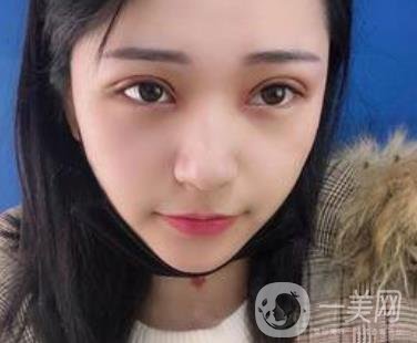 恩施州中心醫(yī)院美容整形科怎么樣？價格表和雙眼皮整形經(jīng)歷分享