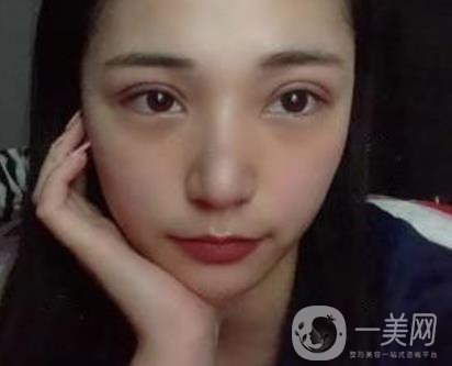 恩施州中心醫(yī)院美容整形科怎么樣？價格表和雙眼皮整形經(jīng)歷分享