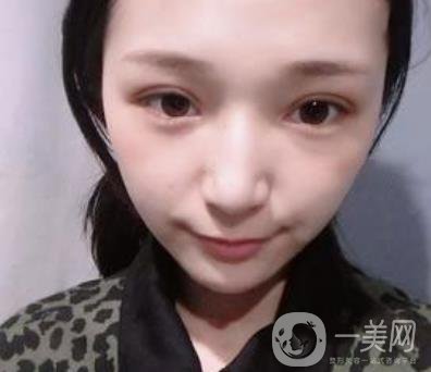 恩施州中心醫(yī)院美容整形科怎么樣？價格表和雙眼皮整形經(jīng)歷分享