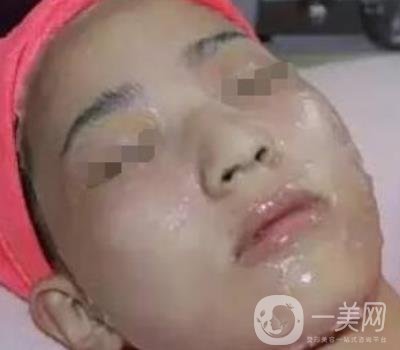 湖南省人民醫(yī)院點(diǎn)陣激光祛斑價(jià)格表及案例分享