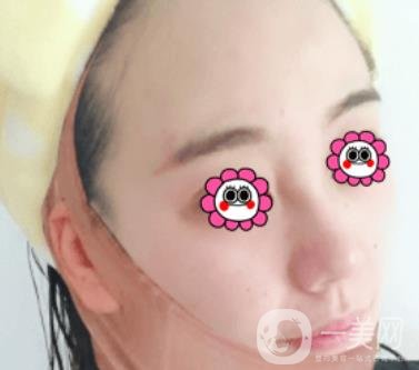 鼓樓醫(yī)院可以打*嗎?附案例恢復(fù)圖及整形價格表