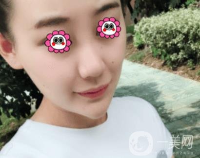 鼓樓醫(yī)院可以打*嗎?附案例恢復(fù)圖及整形價格表