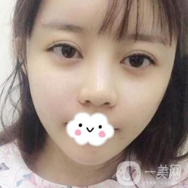 玫瑰醫(yī)院脂肪填充