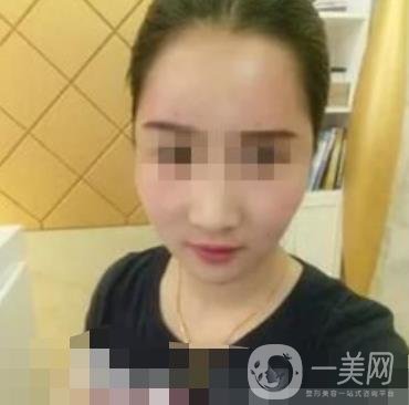 河南省人民醫(yī)院脂肪填充