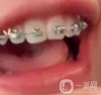 龍崗中心醫(yī)院整牙多少錢？價格表2020收費明細公開一覽