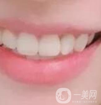 龍崗中心醫(yī)院整牙多少錢？價格表2020收費明細公開一覽