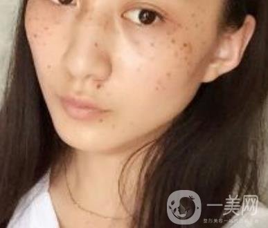 安醫(yī)一附院整形外科價(jià)格表2020版，還有激光祛斑案例