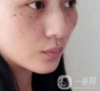 安醫(yī)一附院整形外科價(jià)格表2020版，還有激光祛斑案例