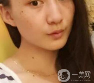 安醫(yī)一附院整形外科價(jià)格表2020版，還有激光祛斑案例