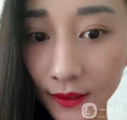 安醫(yī)一附院整形外科價(jià)格表2020版，還有激光祛斑案例