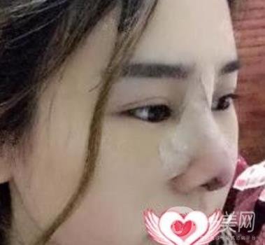 上海市第一人民醫(yī)院整形科隆鼻大概要多少錢?附價格明細(xì)一覽表