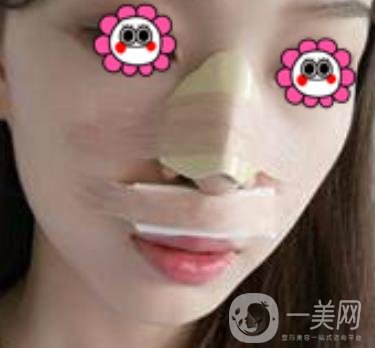 沈陽(yáng)杏林崔昌墉做鼻子怎么樣?2020整形價(jià)格表一覽