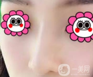 沈陽(yáng)杏林崔昌墉做鼻子怎么樣?2020整形價(jià)格表一覽