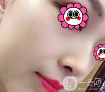 沈陽(yáng)杏林崔昌墉做鼻子怎么樣?2020整形價(jià)格表一覽