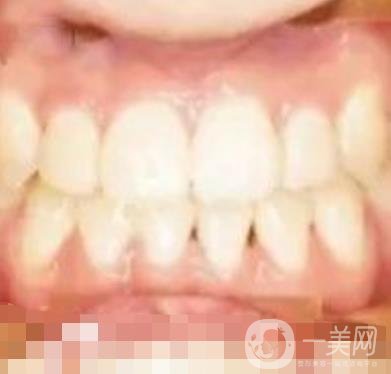 鄭大一附院口腔正畸怎么樣?附項目價格表及案例圖