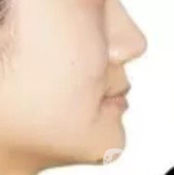 鄭大一附院口腔正畸怎么樣?附項目價格表及案例圖