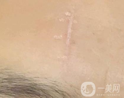 鄭大一附院祛疤怎樣?附2020整形價格表及案例*果圖