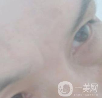 鄭大一附院祛疤怎樣?附2020整形價格表及案例*果圖