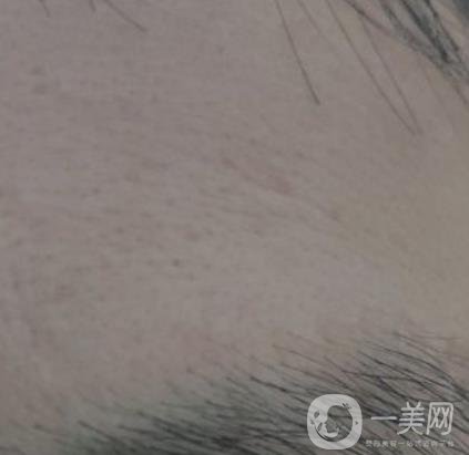 鄭大一附院祛疤怎樣?附2020整形價格表及案例*果圖