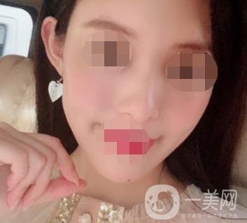 南大一附院整形美容科價(jià)格表2020版及祛疤案例
