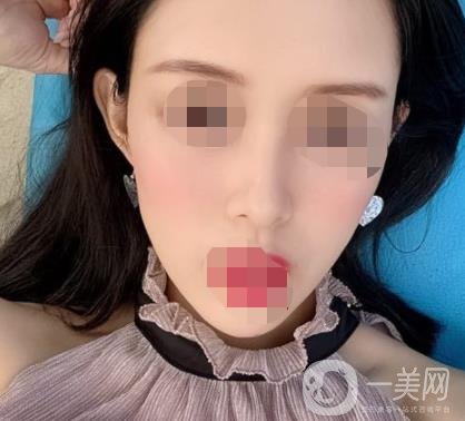 南大一附院整形美容科價(jià)格表2020版及祛疤案例