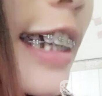 桂林美奧口腔醫(yī)院價(jià)格表全新版，附牙齒矯正案例