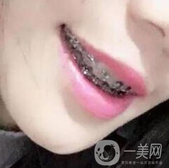 桂林美奧口腔醫(yī)院價(jià)格表全新版，附牙齒矯正案例