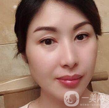 沈陽軍區(qū)總醫(yī)院整形外科價格表，附雙眼皮真實案例