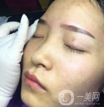 北京朝陽醫(yī)院整形中心紋眉*果怎么樣？價格價目表詳情一覽