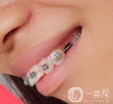 復(fù)旦大學(xué)附屬兒科醫(yī)院口腔科做牙齒矯正多少錢(qián)？?jī)r(jià)格表明細(xì)一覽