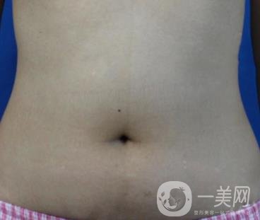 哈爾濱醫(yī)科大學附屬第一醫(yī)院整形科價格表和吸脂瘦肚子全新公布