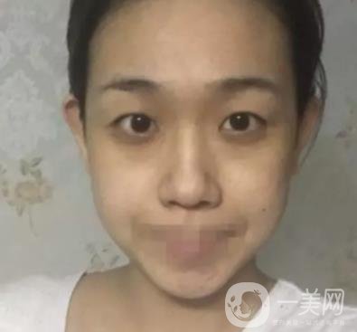 重慶醫(yī)科大學(xué)附屬第一醫(yī)院整形科價格價目表，附雙眼皮*果圖